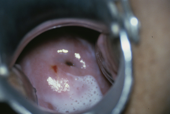 /public/images/ambulatory_content/BV vag.1.jpg